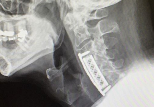 Hawkeye for cervical use - Hawkeye
