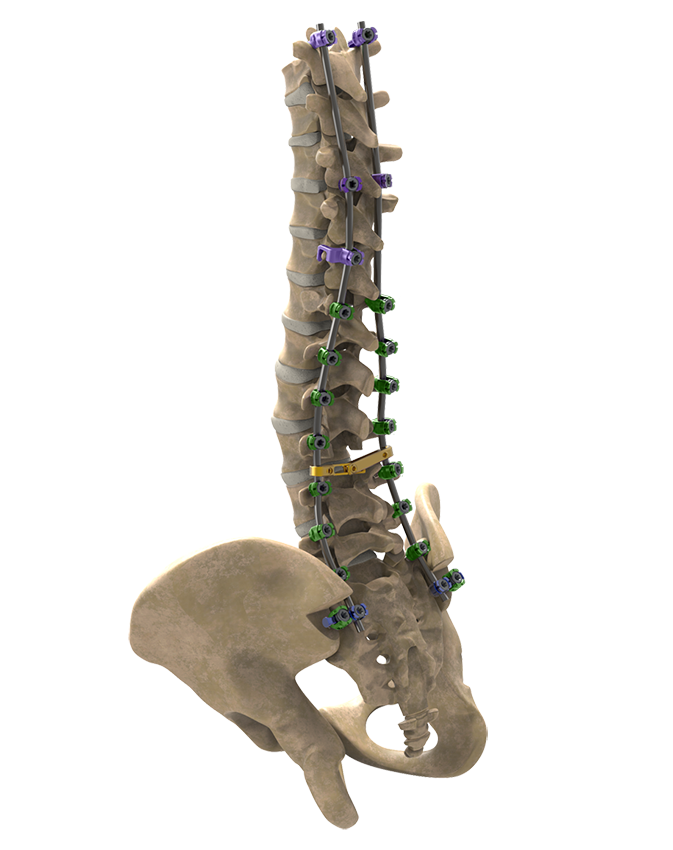 LANCER™ lancer bone 1 - LANCER™